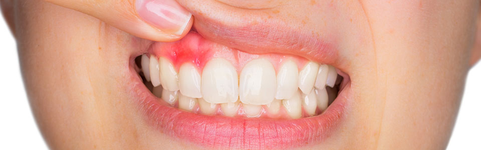 日本人の80%が罹患しているといわれる歯周病